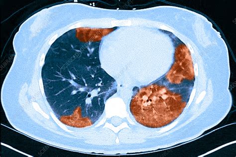 Lungs with vaping damage, baseline CT - Stock Image - C050/4442 ...