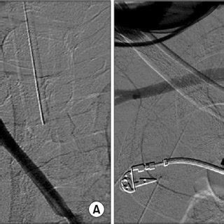 (A) A catheter was inserted through the femoral artery into the right ...