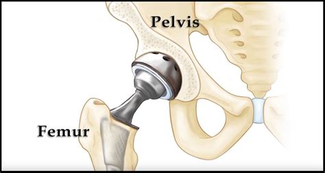 Dislocation After Hip Replacement - OrthoInfo - AAOS