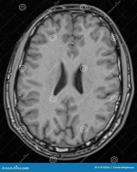 MRI Brain Axial View stock photo. Image of slice, human - 61925056