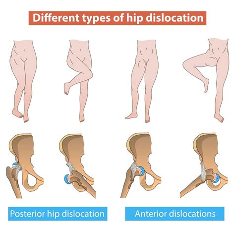 Expert Treatment for Hip Dislocation | Sforzo Dillingham