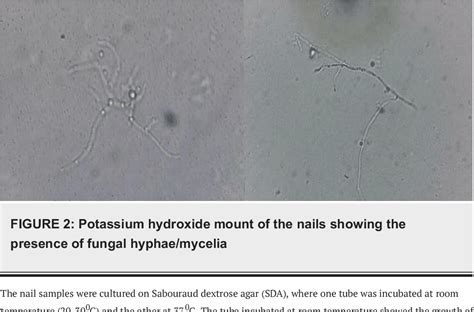 Figure 1 from Total Dystrophic Onychomycosis of All the Nails Caused by ...