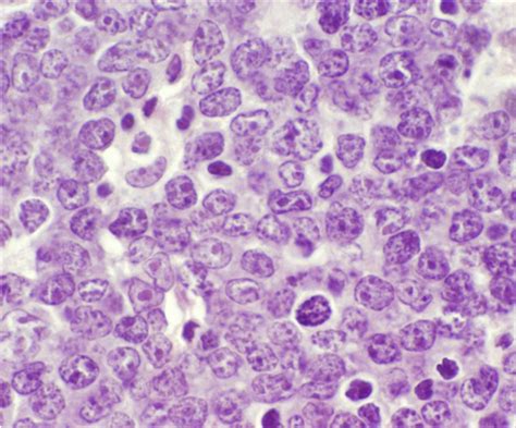 Diffuse Large B-Cell Lymphoma (DLBCL) | Genomic Testing Cooperative