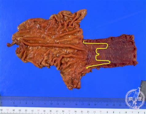 Barretts Esophagus Histology