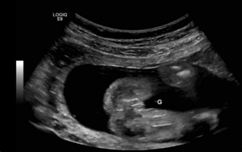 21 week ultrasound. Boy or Girl guesses? - Pregnancy - BabyCenter Canada