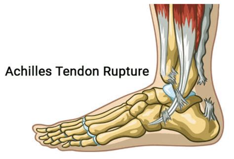 Achilles Tendon Rupture: Orthopedic Center for Sports Medicine: Sports ...