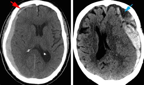 Acute Subdural Hematoma | The Neurosurgical Atlas