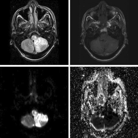 On MRI (top panel), a focal left pontine intra-axial infarct is seen as ...