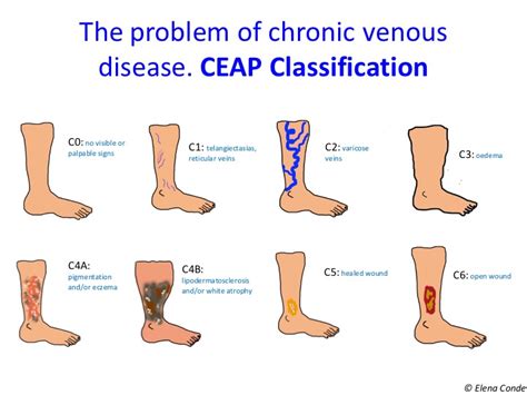 The problem of chronic venous disease. CEAP Classification - Elena Conde