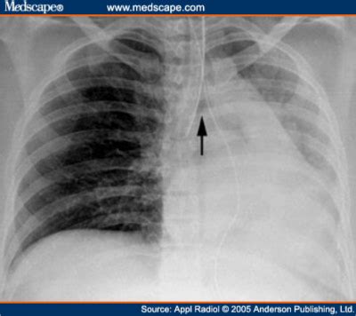 2014 Proper Endotracheal Tube (PET) Detector