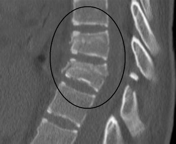 Thoracic Spine Fracture - Physiopedia