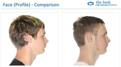 Overbite Before And After Profile