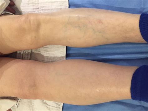 LEG SWELLING: BEFORE AND AFTER PHOTOS FOLLOWING THE PLACEMENT OF AN ...