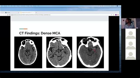 Dr Neupane Malignant MCA Syndrome - YouTube