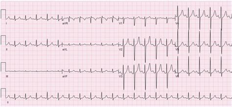 A 28 yo woman with sinus tachycardia - CARDIAC BOOTCAMP