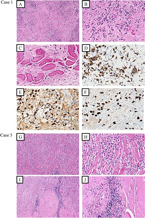 Riedel’s thyroiditis: clinical presentation, treatment and outcomes ...