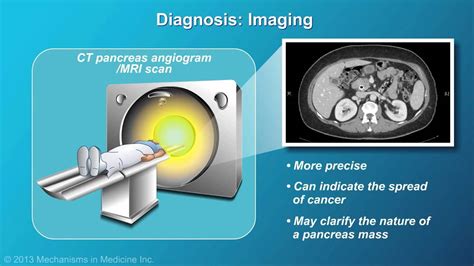 Pancreatic Cancer: Pathophysiology, Diagnosis and Staging - YouTube