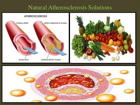 Natural Atherosclerosis Treatment