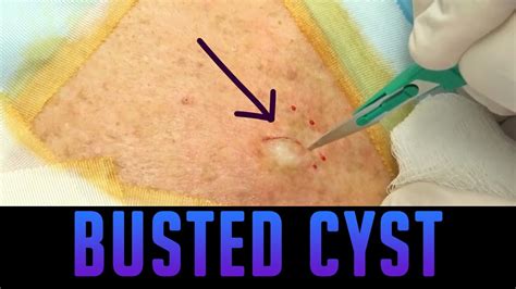 Inclusion Cyst Treatment