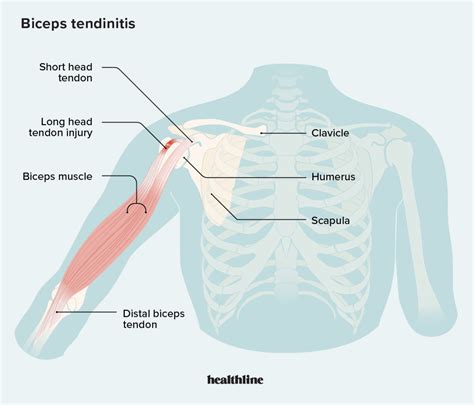 Biceps Tendonitis: How Arthroscopic Surgery Relieves, 51% OFF