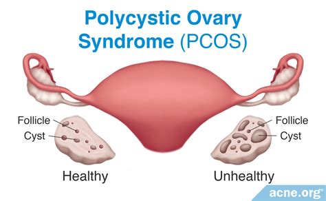 What Is Polycystic Ovary Syndrome (PCOS), and How Does It Affect Acne ...