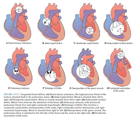 Advanced Pathophysiology - Congenital Heart Defects | Congenital heart ...