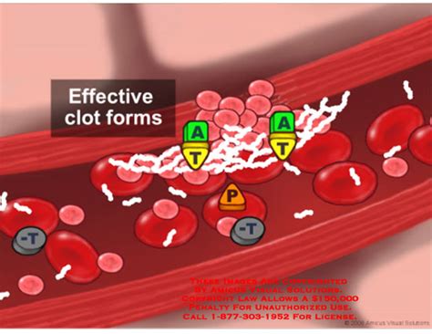 AMICUS Illustration of amicus,animation,2D,anatomy,blood,clotting ...