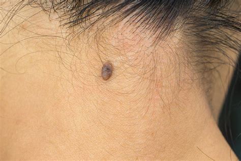 Melanoma on scalp pictures: early stage 1, scalp melanoma images ...