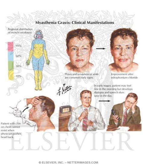 Myasthenia Gravis: Clinical Manifestations