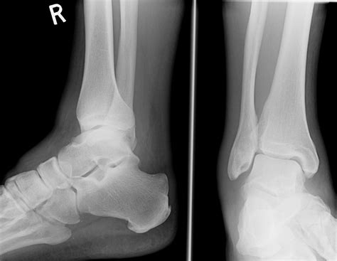 When is an X-Ray Necessary after an Ankle Sprain? - Omaha Physical ...