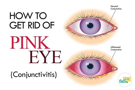 How to Get Rid of Pink Eye (Conjunctivitis) without Antibiotics | Fab How