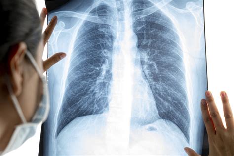 Chest X Ray Bronchitis Vs Pneumonia