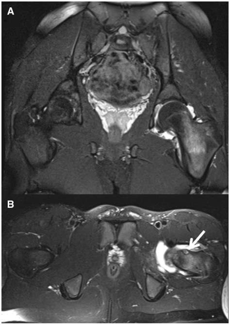 (A) STIR coronal MRI demonstrating bone marrow edema of the left ...