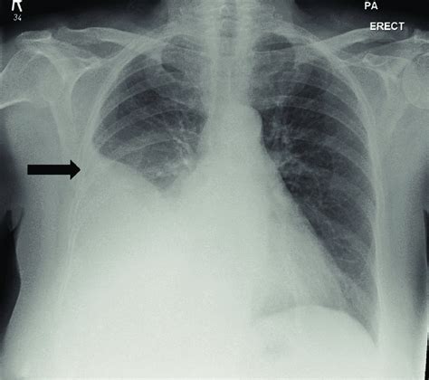 Chest X-ray showed the presence of right-sided pleural effusion ...