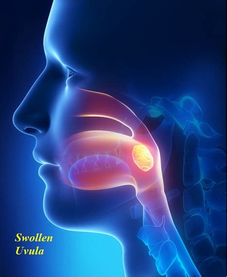 Swollen Uvula - Causes, Symptoms, Pictures, Treatment and Prevention ...