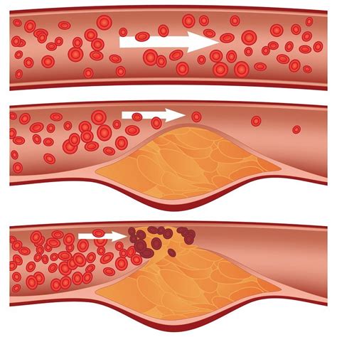 What Is Atherosclerosis;Diagnosis,Treatment And Prevention