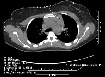 A rare complication of mediastinal mass biopsy