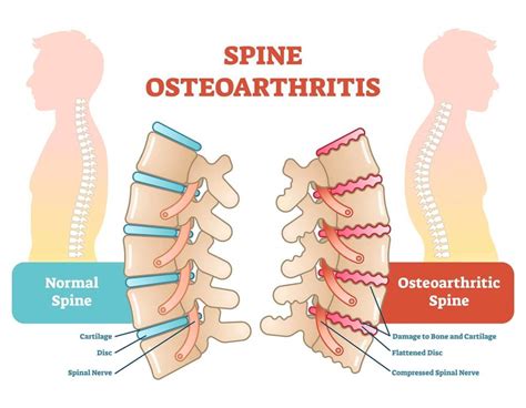 Severe Lower Back Pain - 5 of the Most Common Causes