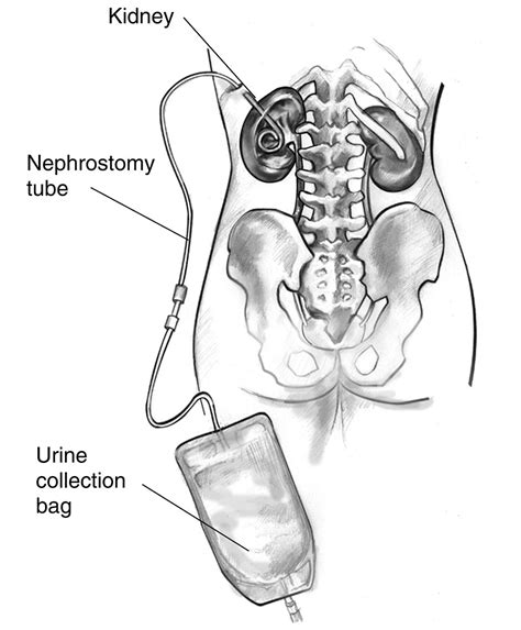 emDOCs.net – Emergency Medicine EducationComplications of Nephrostomy ...