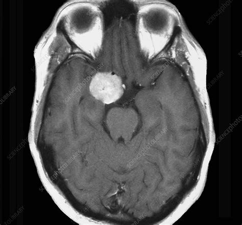 Brain Mri Tumor