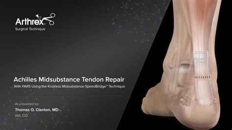 Arthrex - Achilles Midsubstance Tendon Repair With PARS Using the ...