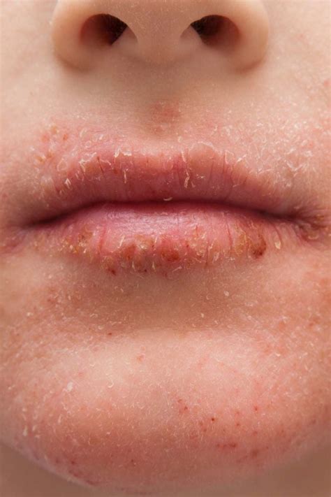 Dry skin around the mouth: Causes, treatment, and remedies