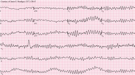 Ventricular Fibrillation ECG 2 | LearntheHeart.com