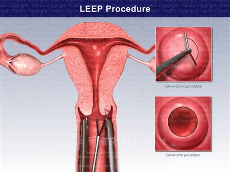 LEEP Procedure - TrialQuest Inc.