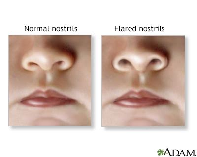 Nasal flaring Information | Mount Sinai - New York