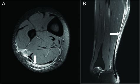 Connective tissue injury in calf muscle tears and return to play: MRI ...