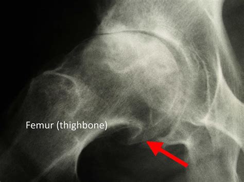 Hip Osteoarthritis - OrthoInfo - AAOS