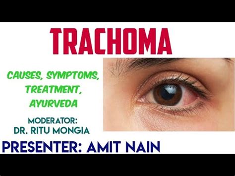 TRACHOMA | SYMPTOMS | TREATMENT | - YouTube