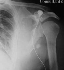 Fracture of the Scapula | Consultant360