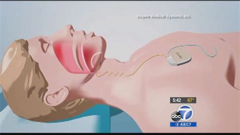 Inspire Upper Airway Stimulation helps those with sleep apnea - ABC7 ...